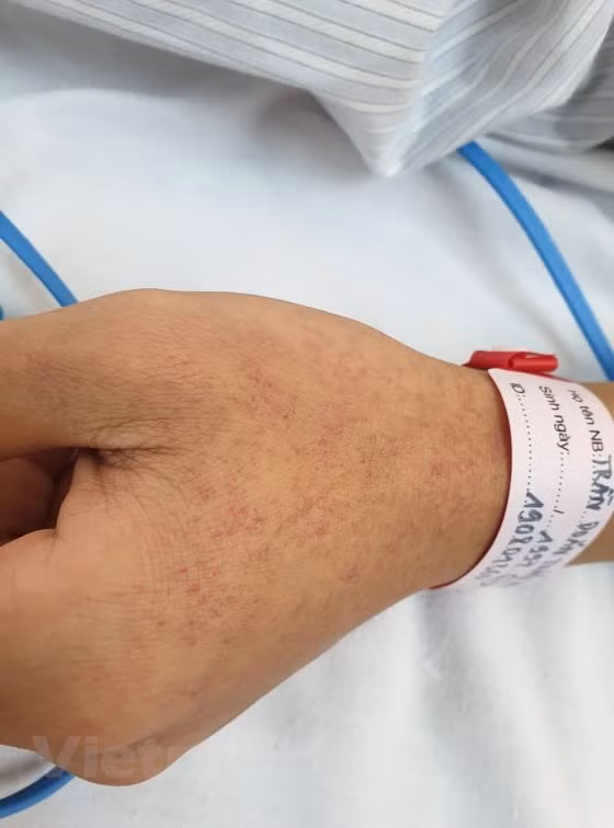 Bệnh nhân mắc sốt xuất huyết. (Ảnh: PV/Vietnam+)