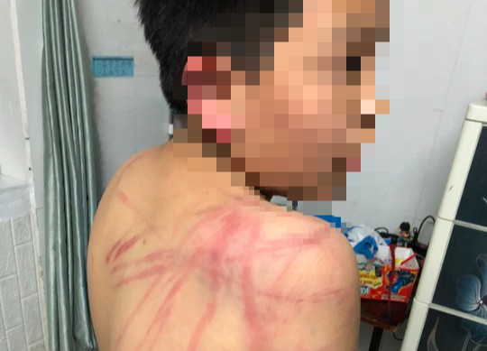 Cháu H. bị chính cha ruột bạo hành Cháu H. bị chính cha ruột bạo hành