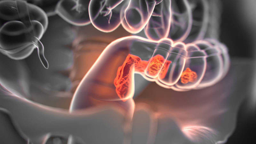 Tỷ lệ mắc ung thư đại trực tràng cao nhất ở những bệnh nhân thuộc nhóm máu O. Ảnh: Shutterstock