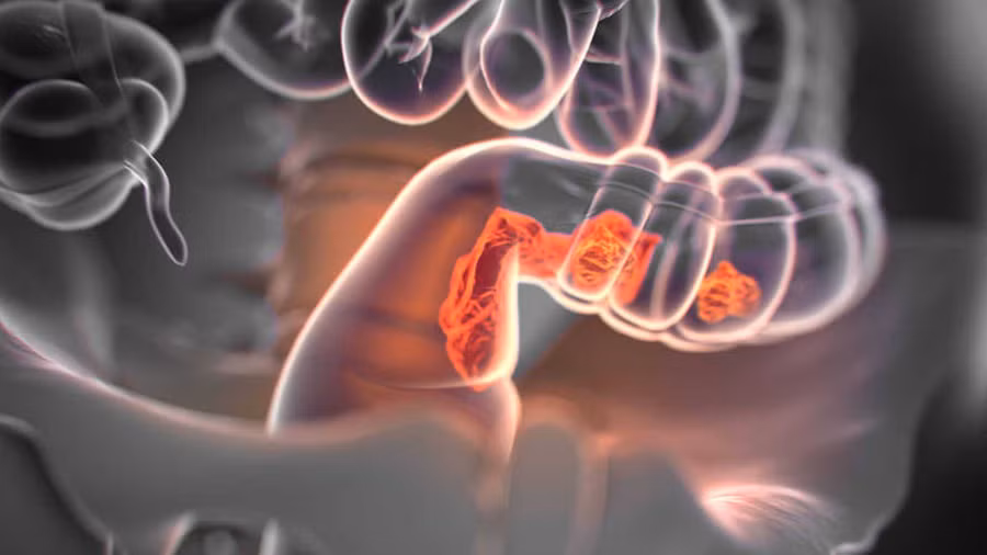 Tỷ lệ mắc ung thư đại trực tràng cao nhất ở những bệnh nhân thuộc nhóm máu O. Ảnh: Shutterstock