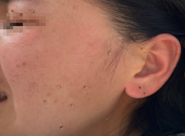 Một nạn nhân bị nhiều nốt ong đốt trên mặt. Ảnh: Bác sĩ cung cấp Một nạn nhân bị nhiều nốt ong đốt trên mặt. Ảnh: Bác sĩ cung cấp