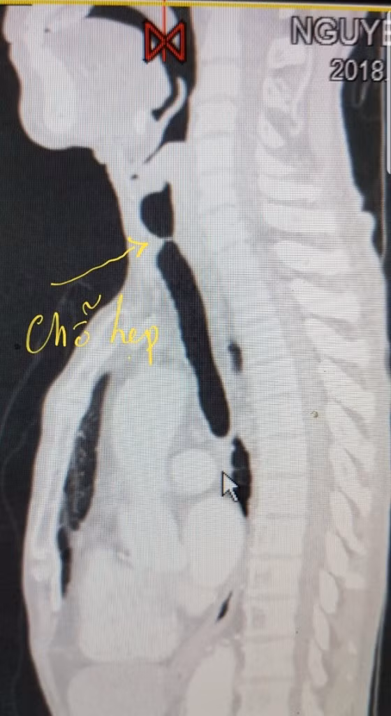 Kết quả chẩn đoán hình ảnh cho thấy bệnh nhân bị tắc đường thở do chèn ép khí quản.