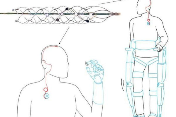 Sau khi cấy ghép, thiết bị ghi lại các tín hiệu não, giải mã và truyền qua một thiết bị khác cấy vào vai người bệnh. Ảnh: ABC