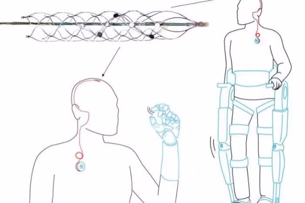 Sau khi cấy ghép, thiết bị ghi lại các tín hiệu não, giải mã và truyền qua một thiết bị khác cấy vào vai người bệnh. Ảnh: ABC