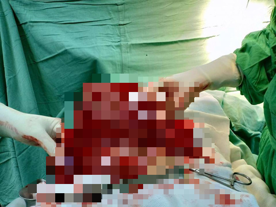 Khối u nặng 4 kg được bóc tách ra khỏi cơ thể bệnh nhân Khối u nặng 4 kg được bóc tách ra khỏi cơ thể bệnh nhân