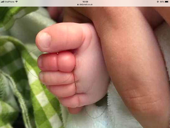  Alex Upton phát hiện một sợi tóc quấn chặt bốn ngón chân của con trai