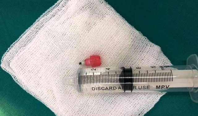 Đầu bút chì dài 2cm được gắp ra từ phế quản của bệnh nhân.