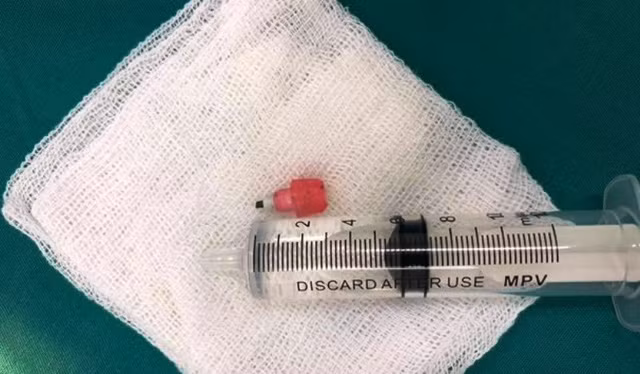 Đầu bút chì dài 2cm được gắp ra từ phế quản của bệnh nhân.