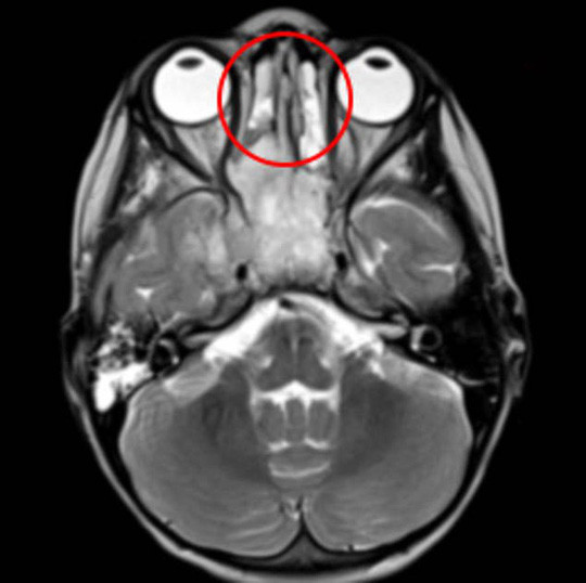 Khối u (khoanh tròn đỏ) được thể hiện trong phim MRI - ảnh do bệnh viện cung cấp Khối u (khoanh tròn đỏ) được thể hiện trong phim MRI - ảnh do bệnh viện cung cấp