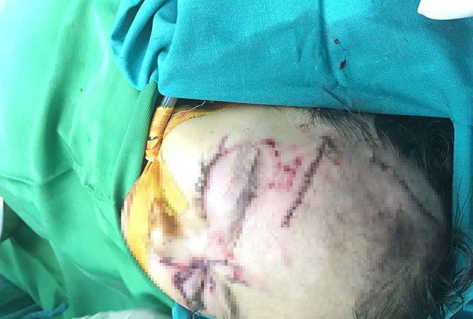  Bé Y. đang được điều trị tích cực tại bệnh viện.