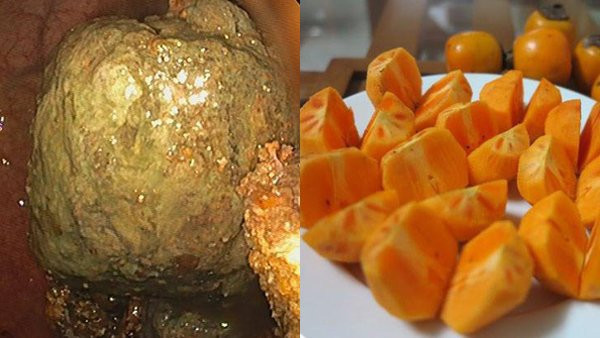 Ăn hồng ngâm khi đói với số lượng lớn có nguy cơ tắc ruột rất cao