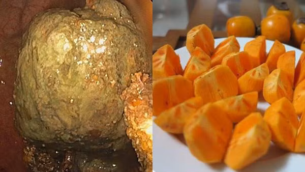 Ăn hồng ngâm khi đói với số lượng lớn có nguy cơ tắc ruột rất cao