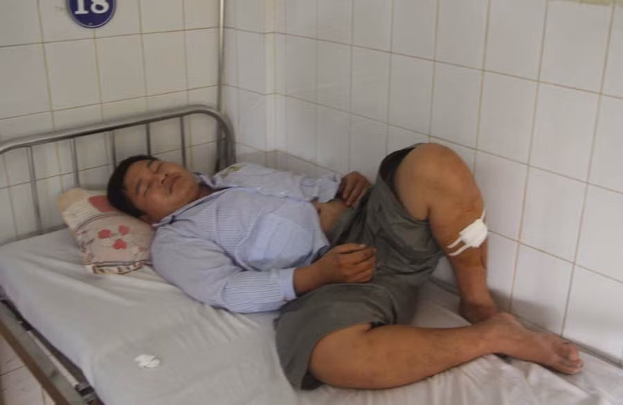 Đối tượng Đinh Văn Mạnh cũng đang được điều trị tại Bệnh viện Đa khoa tỉnh. Ảnh: Văn Ngọc