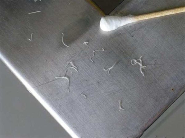 Cận cảnh những con giun sán sau khi được lấy ra từ trong mắt của Minh Minh Cận cảnh những con giun sán sau khi được lấy ra từ trong mắt của Minh Minh