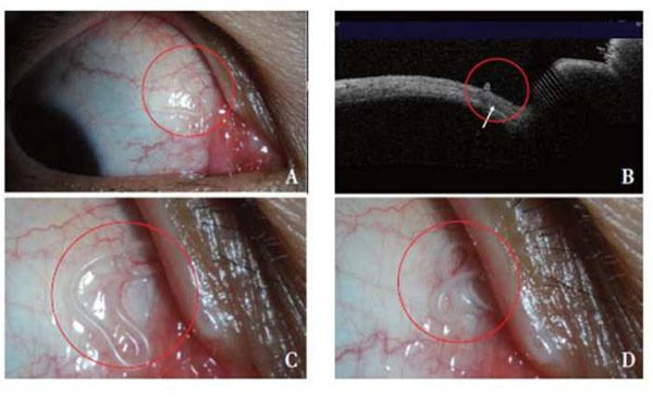 Nếu không được phát hiện và điều trị kịp thời Minh Minh đã có thể bị mù, thậm chí là ảnh hưởng đến não và tử vong Nếu không được phát hiện và điều trị kịp thời Minh Minh đã có thể bị mù, thậm chí là ảnh hưởng đến não và tử vong