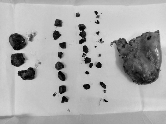 50 viên sỏi lấy ra khỏi người đàn ông