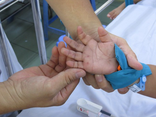 Tay một cháu bé thể hiện rõ hồng ban tay chân miệng - Ảnh: ANH THƯ