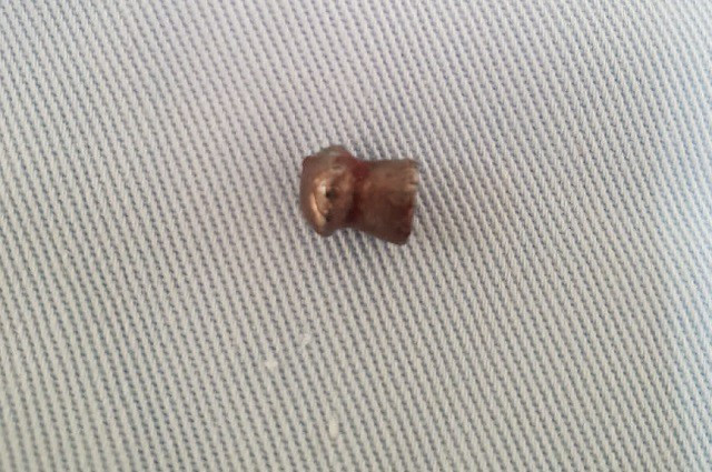 Viên đạn được lấy ra từ người anh Kỳ sau khi phẫu thuật.