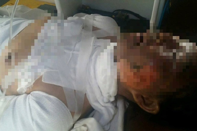 Chị Bé lúc bị bỏng nặng điều trị tại bệnh viện