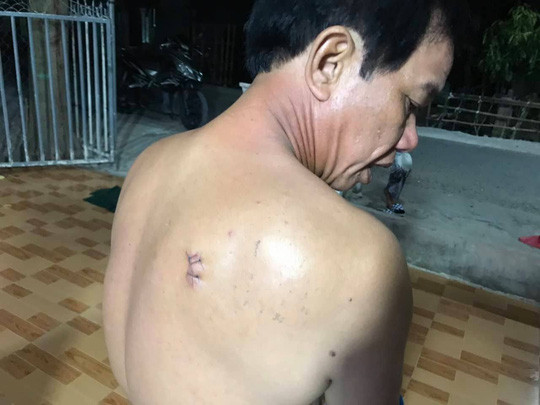 Ông Nhàn cũng bị vết thương dưới vai phải. Ảnh do gia đình nạn nhân cung cấp