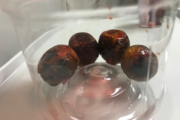 4 viên sỏi to như quả mận trong túi mật bệnh nhân 4 viên sỏi to như quả mận trong túi mật bệnh nhân