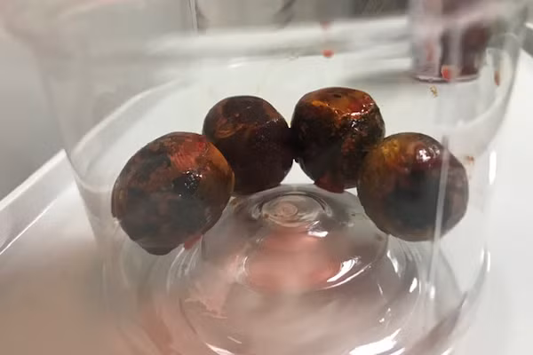  4 viên sỏi to như quả mận trong túi mật bệnh nhân