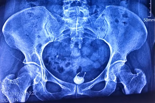 Ảnh chụp X-quang cho thấy vòng tránh thai bị mắc kẹt ở bàng quang người phụ nữ. Ảnh: BSCC