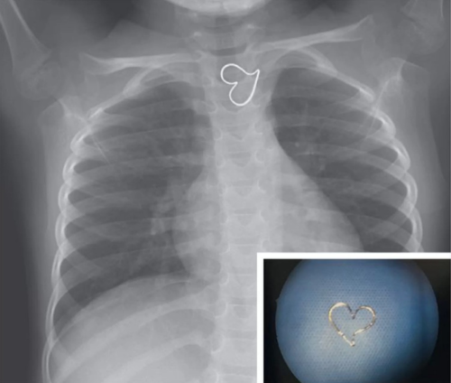 Ảnh chụp X-quang của em bé ba tuổi. Ảnh: NEJM.