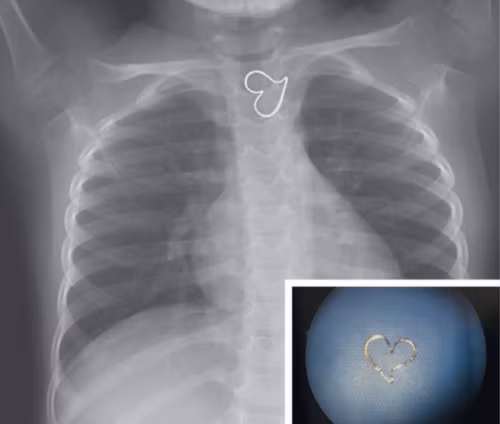 Ảnh chụp X-quang của em bé ba tuổi. Ảnh: NEJM.