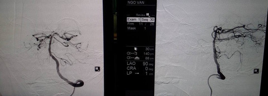  Sau bơm thuốc mạch máu chưa tái thông