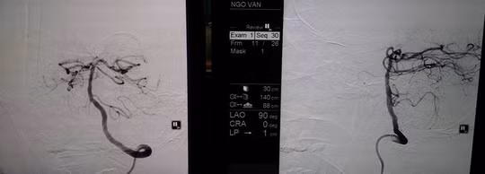  Sau bơm thuốc mạch máu chưa tái thông