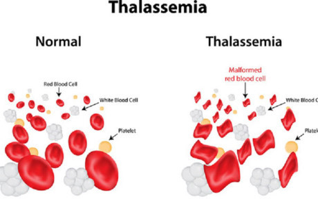 Hình ảnh hồng cầu dễ vỡ trong bệnh Thalassemia. Hình ảnh hồng cầu dễ vỡ trong bệnh Thalassemia.
