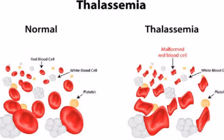Hình ảnh hồng cầu dễ vỡ trong bệnh Thalassemia.