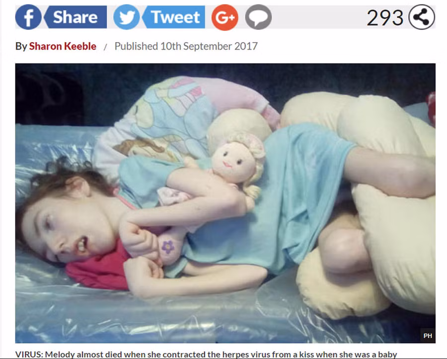 Bé Melody bị liệt bên trái vì bị lây vi rút Herpes từ khi mới sinh bởi nụ hôm của người đến thăm. (Ảnh chụp màn hình Daily Star Sunday)