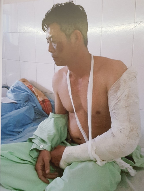 Ông Hậu bị chém gần đứt lìa cánh tay, thương tích 43%.