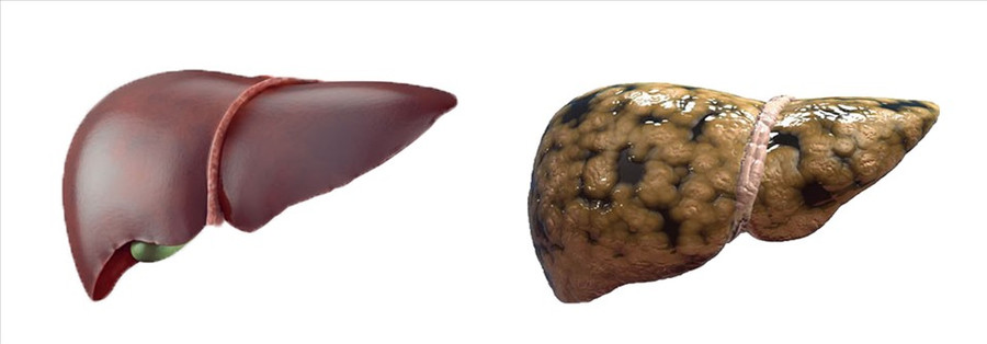 Gan nhiễm mỡ tiềm ẩn nguy cơ mắc các bệnh nguy hiểm. Đồ họa: Hồng Nhật