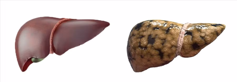 Gan nhiễm mỡ tiềm ẩn nguy cơ mắc các bệnh nguy hiểm. Đồ họa: Hồng Nhật