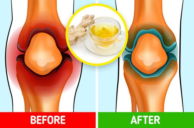 Trà gừng có thể giảm đau đầu gối. ẢNH SHUTTERSTOCK Trà gừng có thể giảm đau đầu gối. ẢNH SHUTTERSTOCK