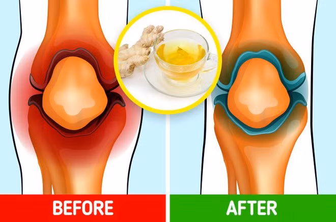 Trà gừng có thể giảm đau đầu gối. ẢNH SHUTTERSTOCK