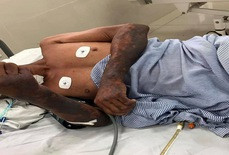 Toàn thân ông C. bị tím tái, 2 cánh tay có dấu hiệu hoại tử Toàn thân ông C. bị tím tái, 2 cánh tay có dấu hiệu hoại tử