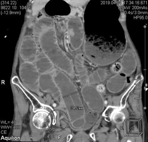 Vị trí bịt ruột gây tắc hoại tử hiếm gặp của bệnh nhân