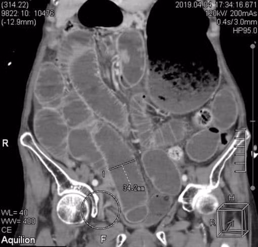 Vị trí bịt ruột gây tắc hoại tử hiếm gặp của bệnh nhân