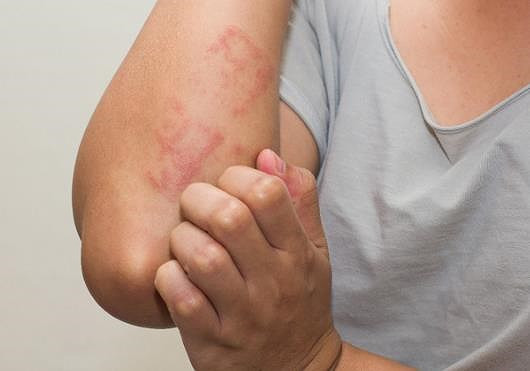  Nổi mẩn đỏ là biểu hiện điển hình của dị ứng thuốc. Ảnh: BVCC