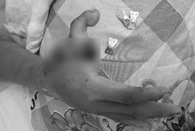 Hình ảnh bàn tay của bệnh nhân sau khi được ghép ngón.