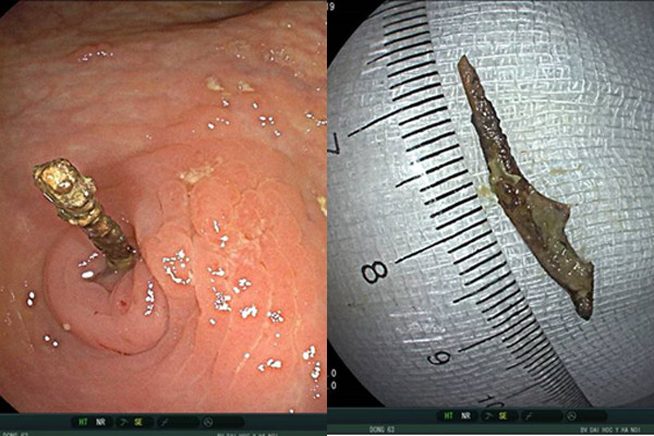 Mảnh xương nhọn cắm sâu trong ruột thừa bệnh nhân 