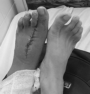  Bệnh nhân được ghép nối ngón chân số 2 của bàn chân trái thành ngón tay cái