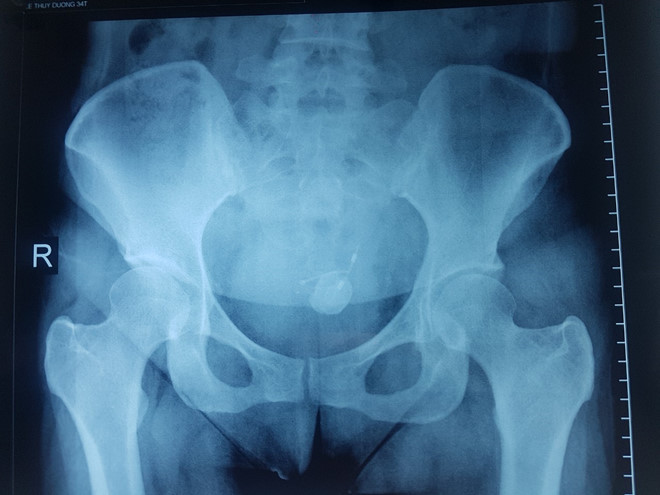  Nhìn kết quả chụp X-quang thấy vòng tránh thai đi 