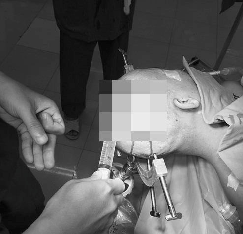 Bác sĩ phẫu thuật loại bỏ khối u cho bệnh nhân. Ảnh: Sức Khỏe Đời Sống. Bác sĩ phẫu thuật loại bỏ khối u cho bệnh nhân. Ảnh: Sức Khỏe Đời Sống.