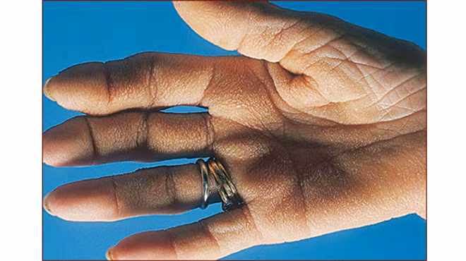  Khoảng 90% các trường hợp bàn tay “bao tử bò” có liên quan đến bệnh ác tính bên trong cơ thể - Ảnh: Shutterstock