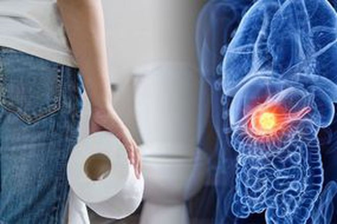 Thay đổi trong thói quen đại tiện là một trong những triệu chứng đầu tiên của ung thư ruột ẢNH MINH HỌA: SHUTTERSTOCK